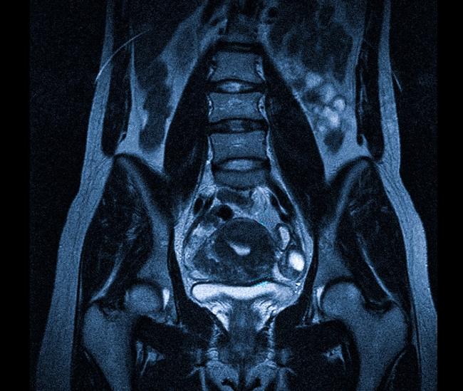 Органы малого таза на МРТ