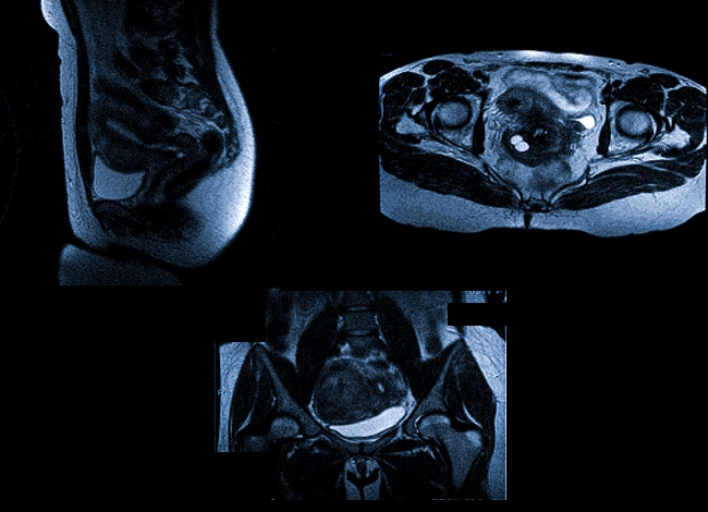МРТ матки в трех проекциях (Т2-ВИ)
