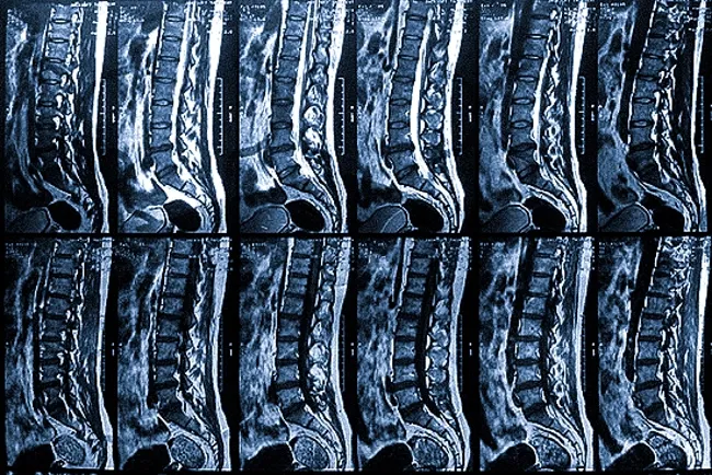 Пленка с серией снимков пояснично-крестцового отдела позвоночника в сагиттальной проекции