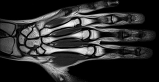 Магнитно-резонансная томография кисти и лучезапястного сустава
