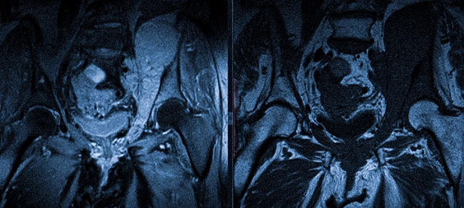 МР-томограмма костей таза