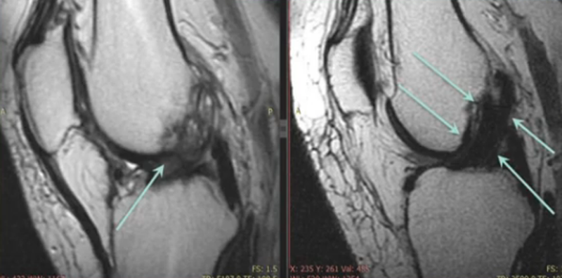 Перелом в коленном суставе на МРТ