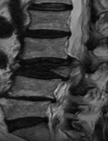 Осложненный компрессионно-оскольчатый перелом тела позвонка в грудном отделе на МРТ