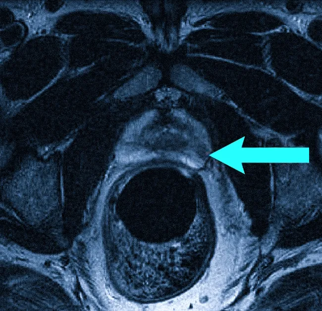 Рак простаты на МРТ, стрелка указывает на образование с низкой интенсивностью сигнала (Т2 ВИ)