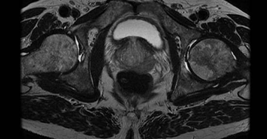 Магнитно-резонансная томография органов малого таза у мужчин