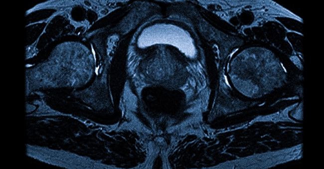 Магнитно-резонансная томография органов малого таза у мужчин