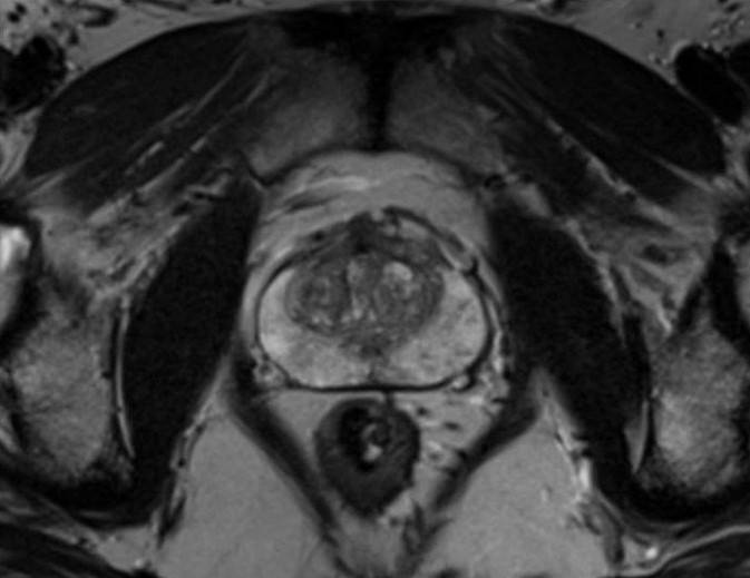 Снимок предстательной железы в результате магнитно-резонансной томографии