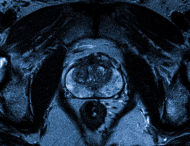 Снимок предстательной железы в результате магнитно-резонансной томографии