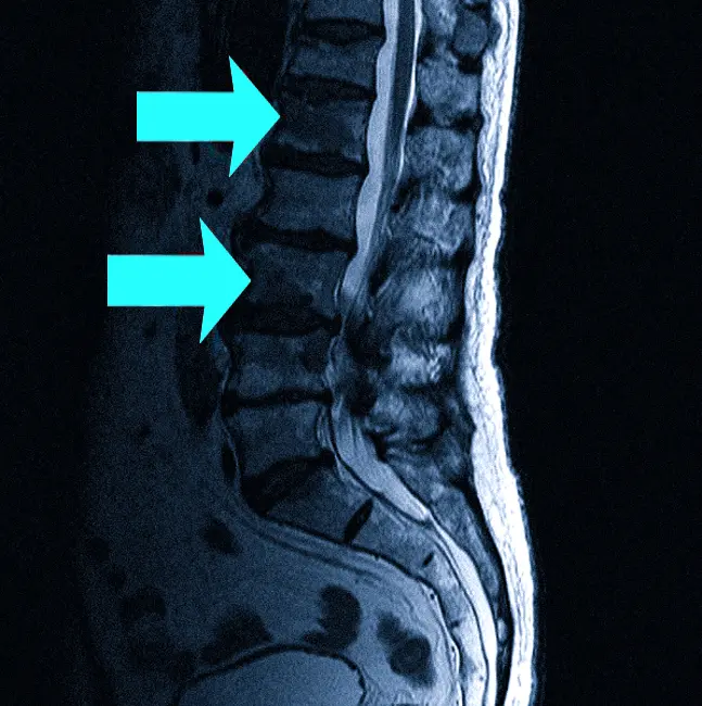 Очаги вторичного поражения позвоночника на МРТ
