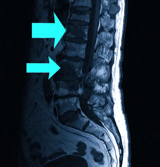 Очаги вторичного поражения позвоночника на МРТ