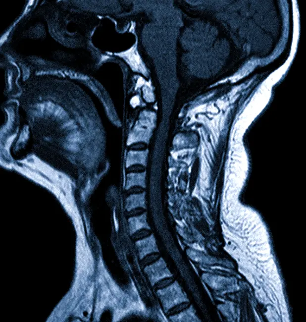 Перелом первого шейного позвонка на МРТ