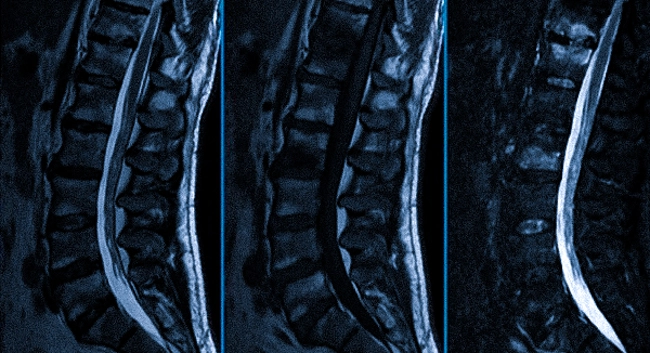 МРТ пояснично-крестцового отдела