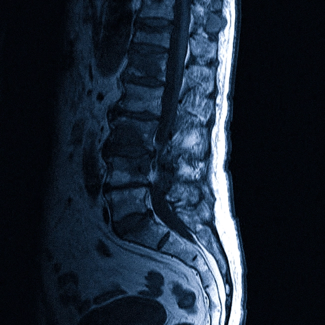 МРТ поясничного отдела позвоночника при остеохондрозе