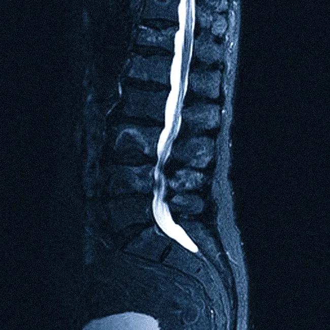 МРТ пояснично-крестцового отдела позвоночника