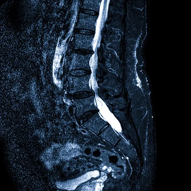 Стеноз позвоночника на МРТ