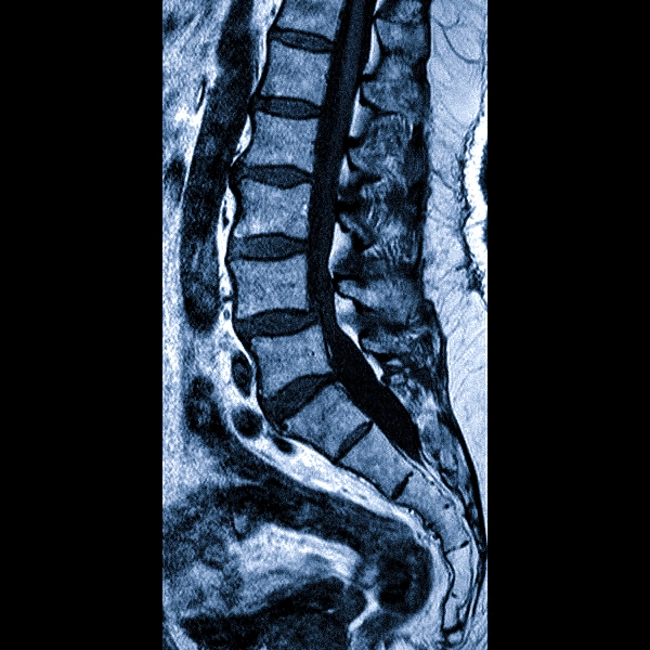 Стеноз позвоночника на МРТ