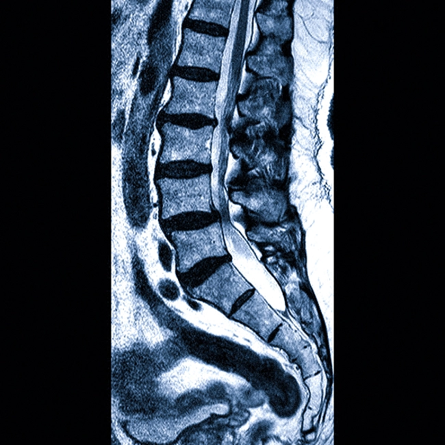 Антелистез поясничных позвонков на МРТ