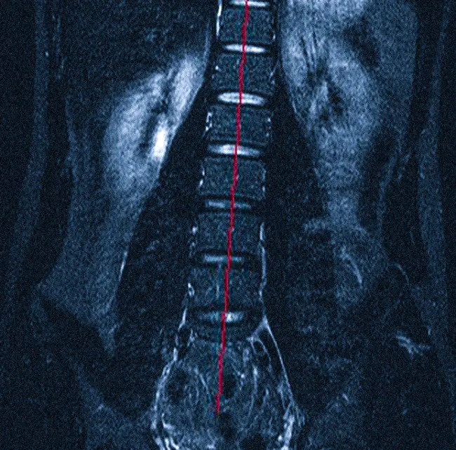 боковое искривление позвоночника на МРТ 