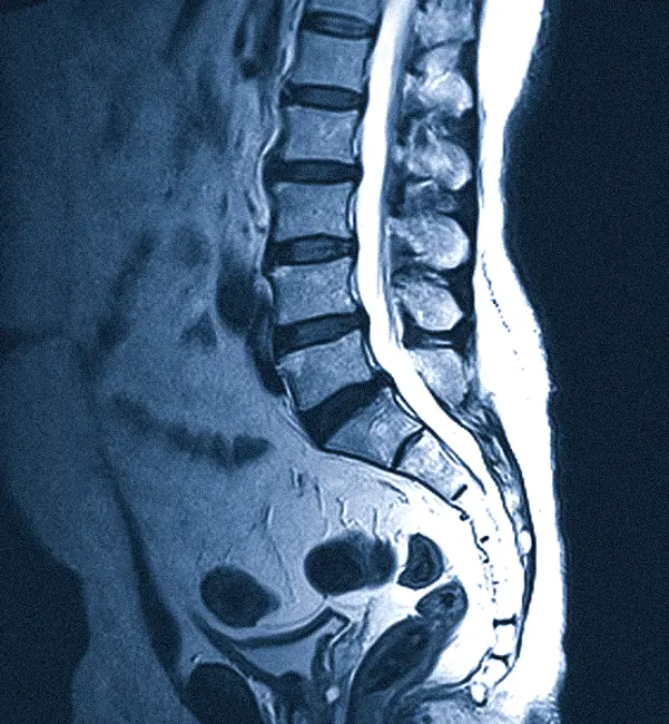 Сагиттальный срез позвоночного столба на МРТ