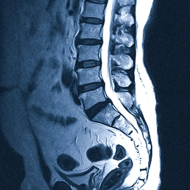 МРТ позвоночника при сколиозе