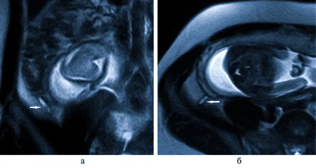 червеобразный отросток позади матки на МРТ