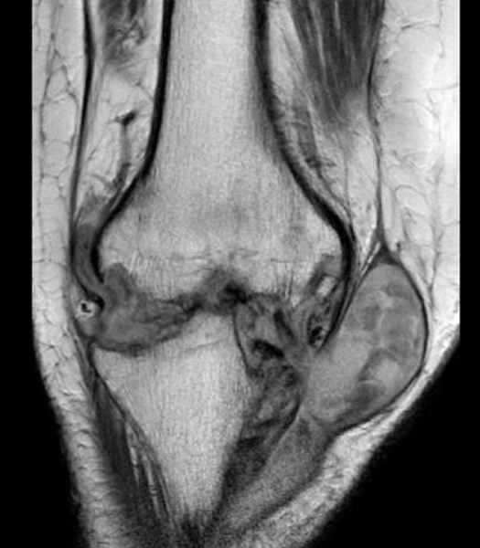 На МРТ выявлен септический артрит коленного сочленения с абсцессом