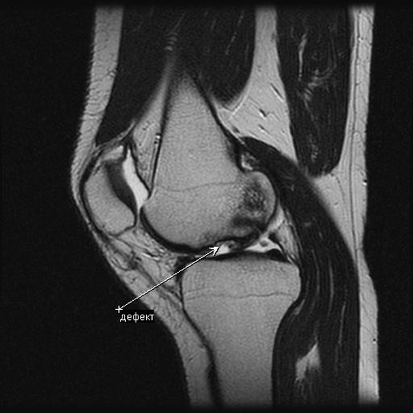 поврежденный мениск на МРТ коленного сустава