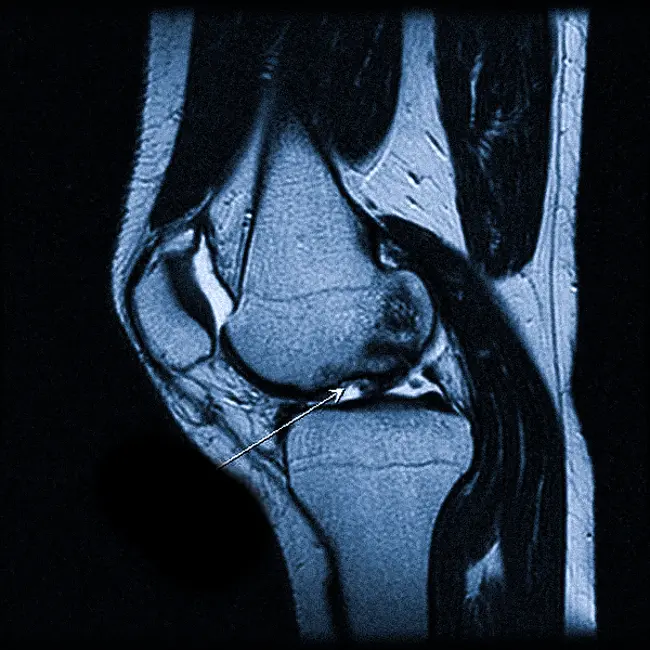 поврежденный мениск на МРТ коленного сустава