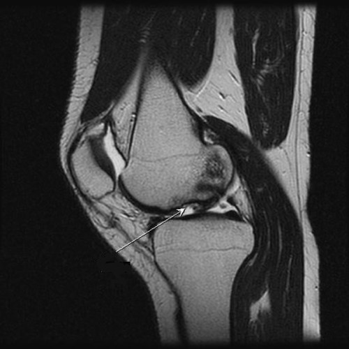 МРТ при артрите коленного сустава