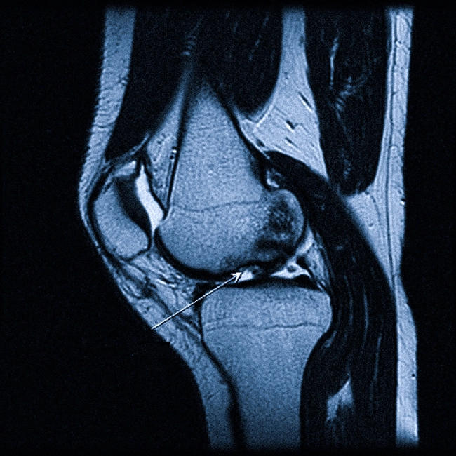МРТ при артрите коленного сустава