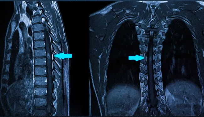 Опухоль спинного мозга в грудном отделе на МРТ