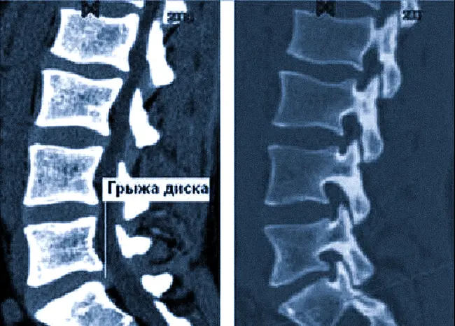 Грыжа межпозвонкового диска в поясничном отделе (показана стрелками) на КТ