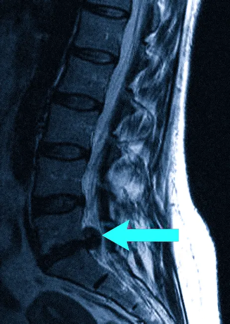 Грыжа межпозвонкового диска в поясничном отделе на МРТ