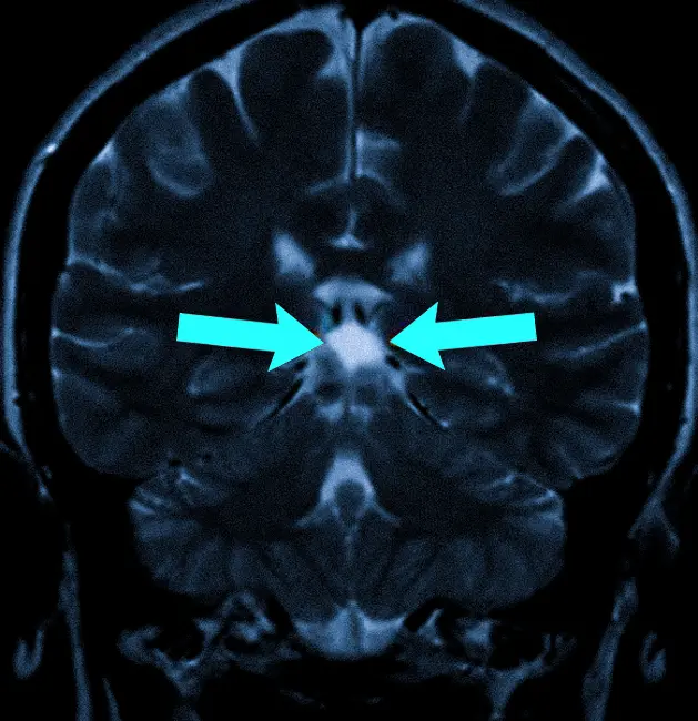 Киста шишковидной железы на МРТ