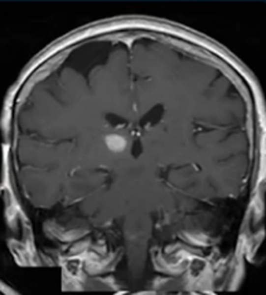 Гематома головы на МРТ