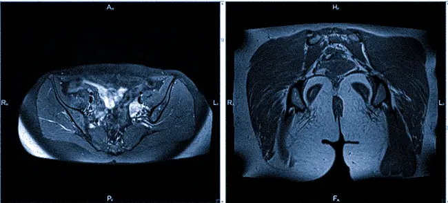 МРТ мягких тканей тазового пояса