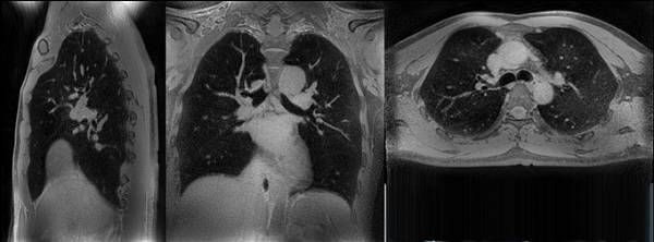Магнитно-резонансная томография легких (сагиттальная, фронтальная, аксиальная проекции)