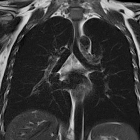 МРТ при пневмонии легких