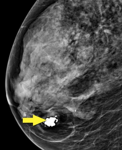 МР-снимок груди