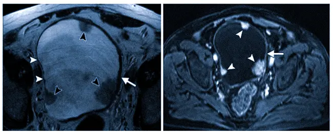 Рак мочевого пузыря на МРТ