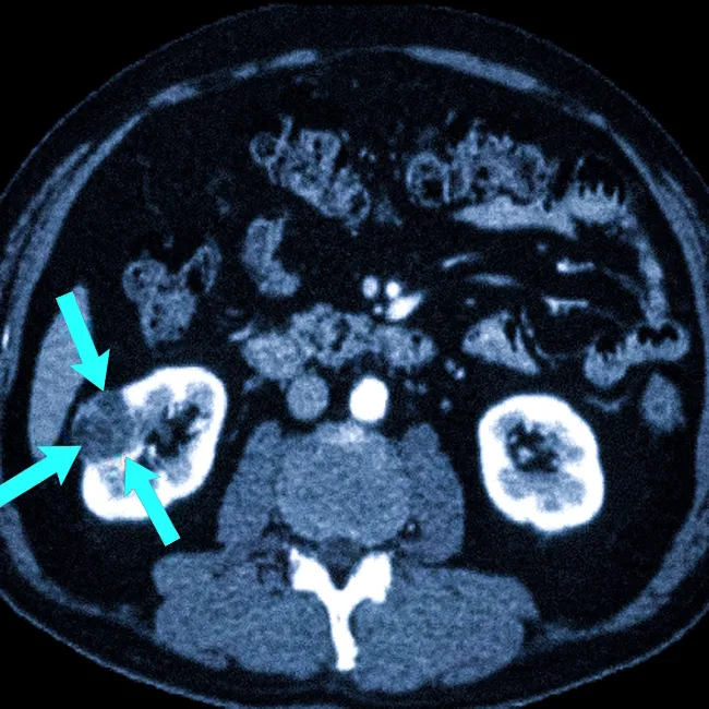 МРТ при раке почки