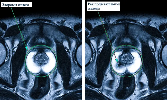 Здоровая предстательная железа и с раком