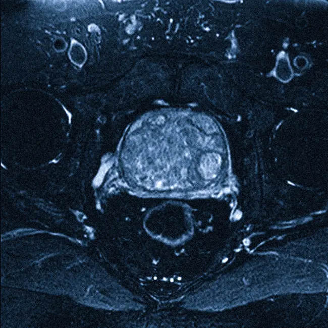 МРТ при раке простаты
