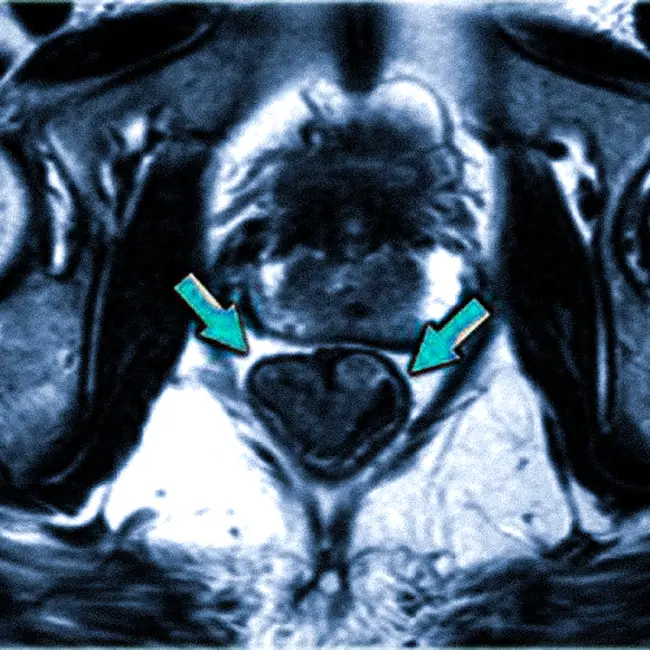 МРТ при раке прямой кишки