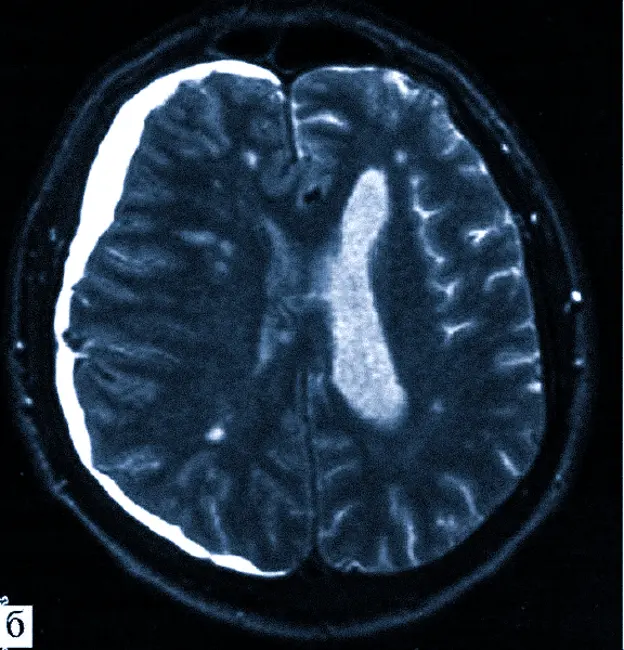 Субдуральная гематома на МРТ