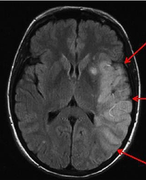 Снимок МРТ при травме головы