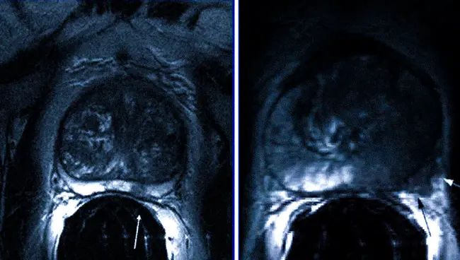 Рак простаты на МРТ