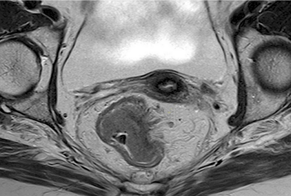 Снимок МРТ прямой кишки