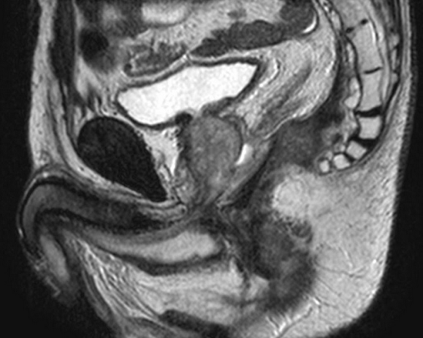 Рак прямой кишки на снимке МРТ