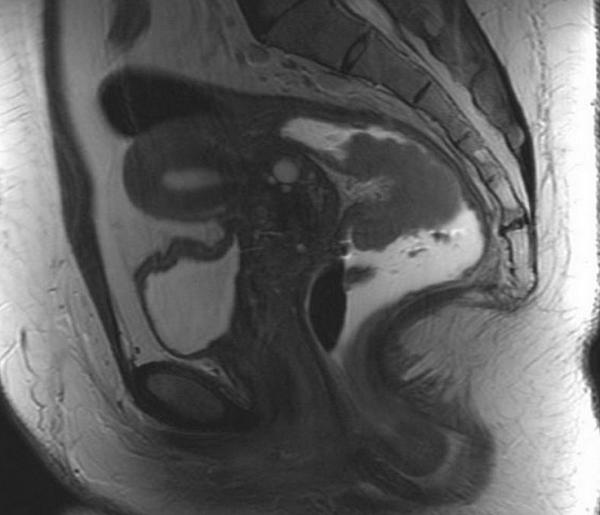Злокачественная опухоль на снимке МРТ